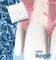 Применение матрикса Mucograft