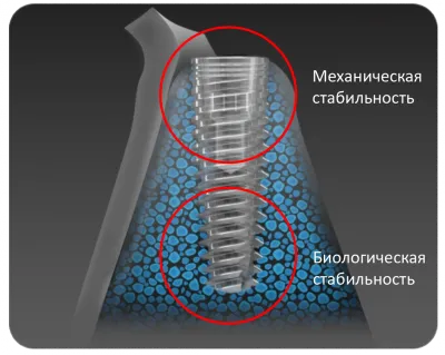 Концепция механизма двойной стабилизации (DSM) в имплантатах С1