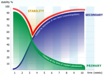 Схема двойной стабилизации имплантата MIS C1