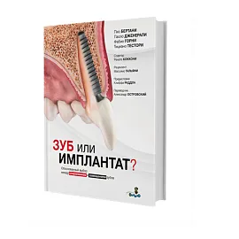 Зуб или имплантат?