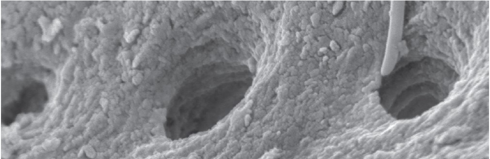 Субантральная аугментация с использованием материала OsteoBiol® mp3Сканирующий электронный микроскоп: пористый костный матрикс OsteoBiol® Gen-Os