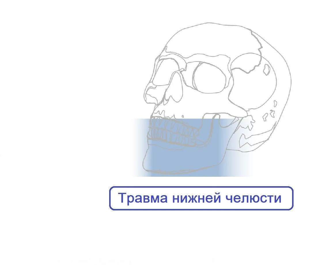 Трамва Нижней Челюсти Пластины Мини