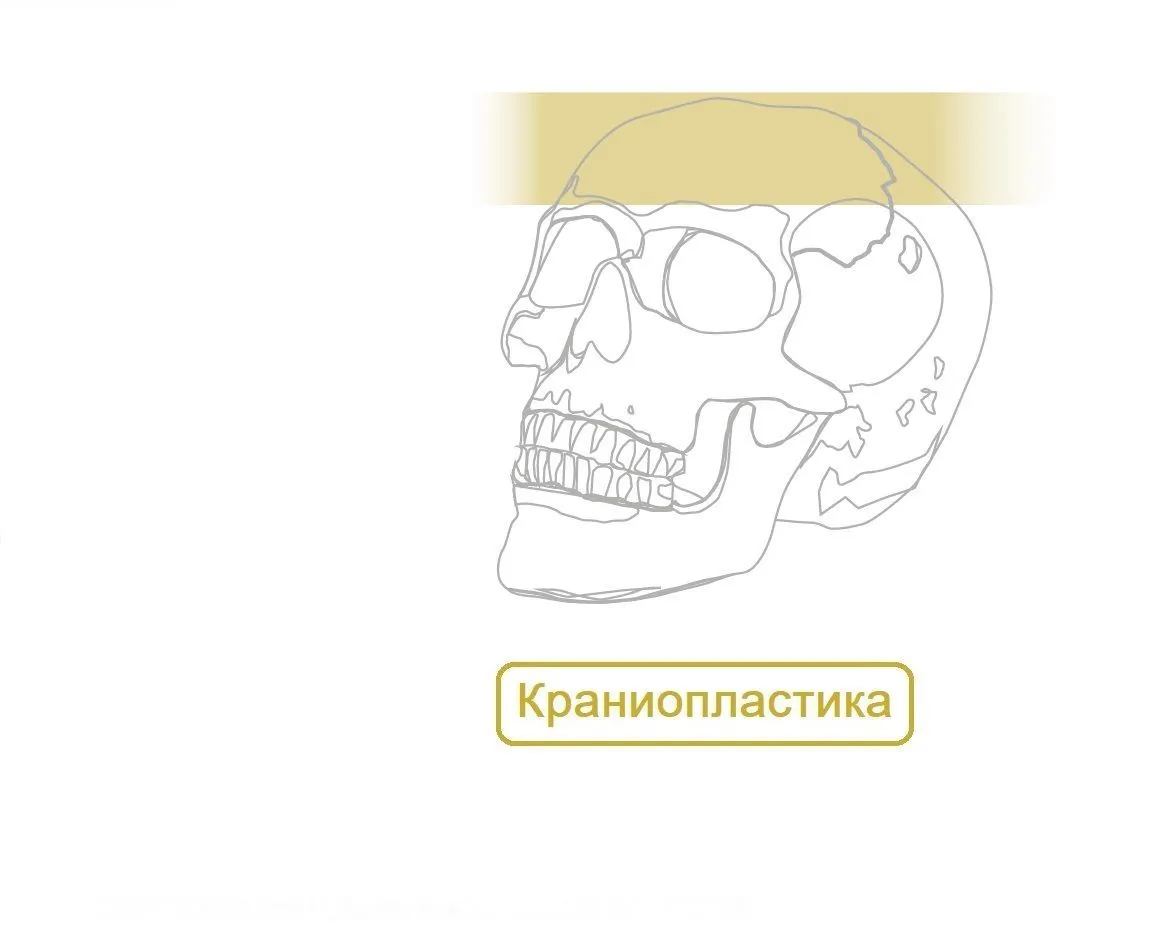 Краниопластика Пластины Микро, Миди, Мини