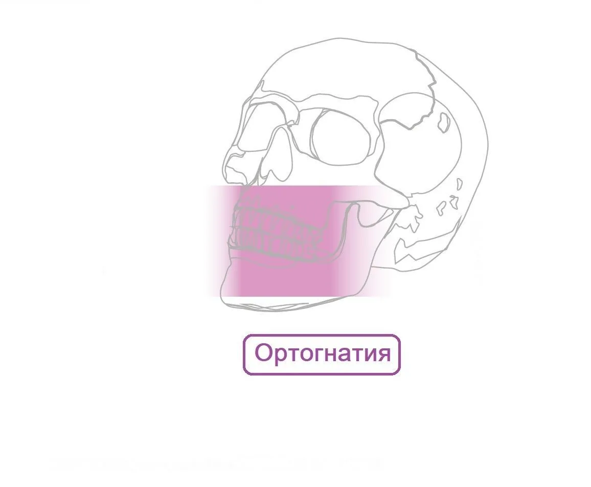 Ортогнатия Пластины Мини