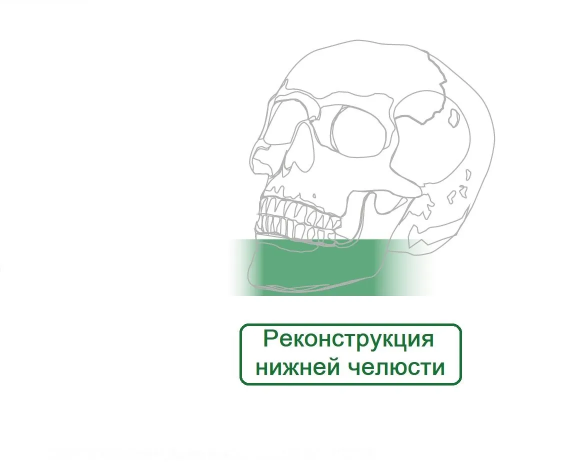Реконструкция Нижней Челюсти Пластины Макси