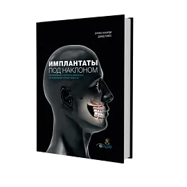 Имплантаты под наклоном. Протезирование с опорой на имплантаты при выраженной атрофии челюстей
