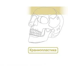 Краниопластика Пластины Микро, Миди, Мини