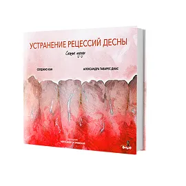 Устранение рецессий десны